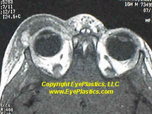 Preseptal periorbital cellulitis &mdash; eyelid swelling and erythema