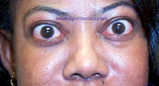 Upper Eyelid Retraction I Pre - Operative Photograph