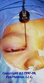 his photo shows a canalicular laceration and its repair with a monocanalicular stent using the Ritleng probe.